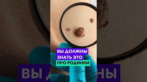 Лучшее время для удаления родинок на лице по лунному календарю