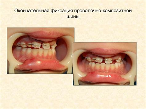 Окончательная фиксация