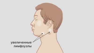  Что такое воспаление лимфоузла 