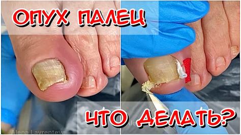 Укол палец рыбной костью: причины и последствия