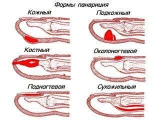 Что делать при уколе рыбной костью на руке