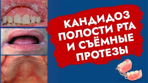 Болезни полости рта и зубы