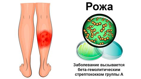 Воспаление и инфекции