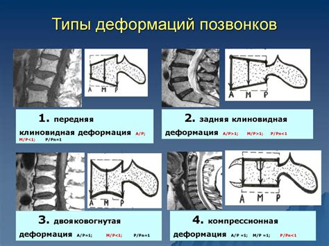 Высота тел позвонков: значение исследований