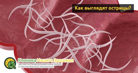 Положительный опыт клиентов при использовании домашних методов устранения остриц