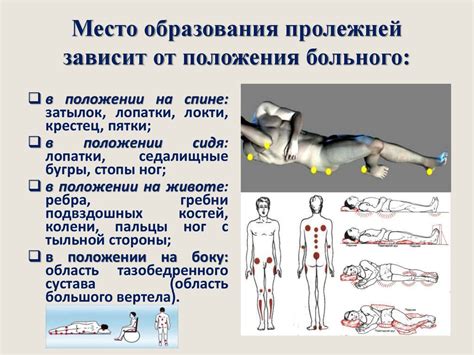 Помощь при пролежнях
