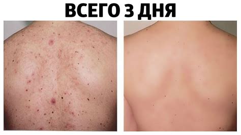 Причины и последствия содранных кожей усиленным воском на лице